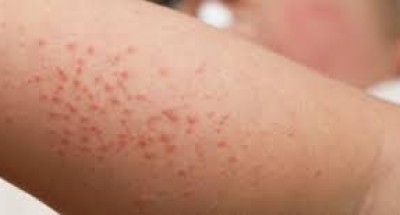 خبير أمراض جلدية: التغيرات المناخية تؤثر على جلد الإنسان وتصيبه بأمراض مختلفة